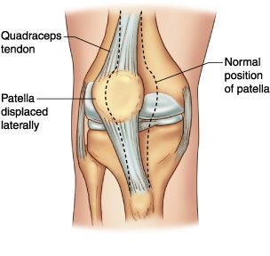 Knee cap store displacement treatment