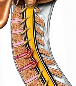 Cervical disc injury