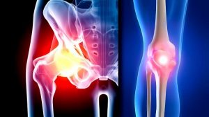 hip and knee arthritis