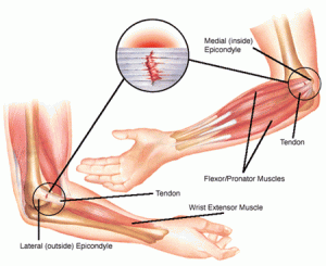 tennis elbow