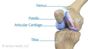 worn knee cartilage