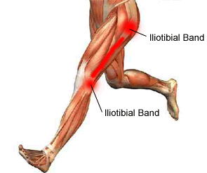 Iliotibial band syndrome(Runner's knee) –